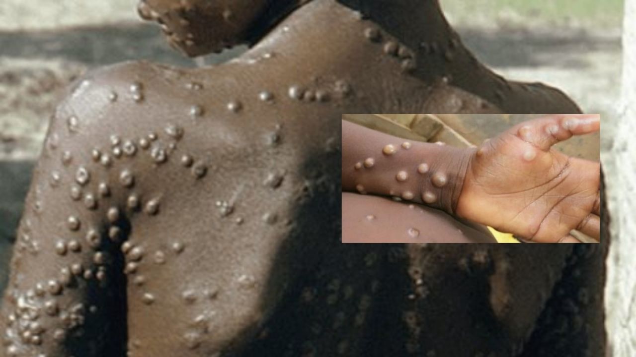 La viruela del mono ha causado 70 muertes en África en lo que va de 2022