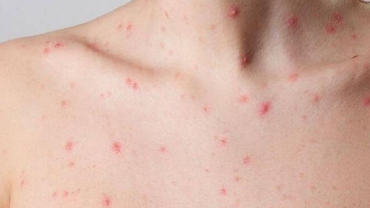 Unión Europea adquiere vacunas contra la viruela del mono tras preocupante aumento de casos