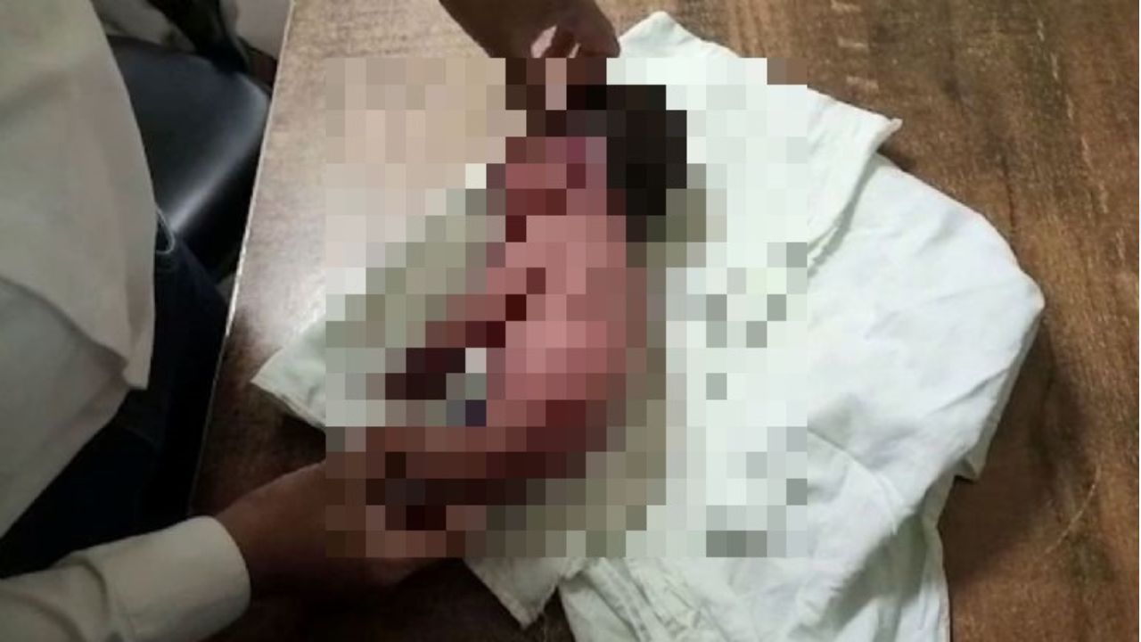 Imagen: Nace bebé con un 'cuerno' en vez de piernas