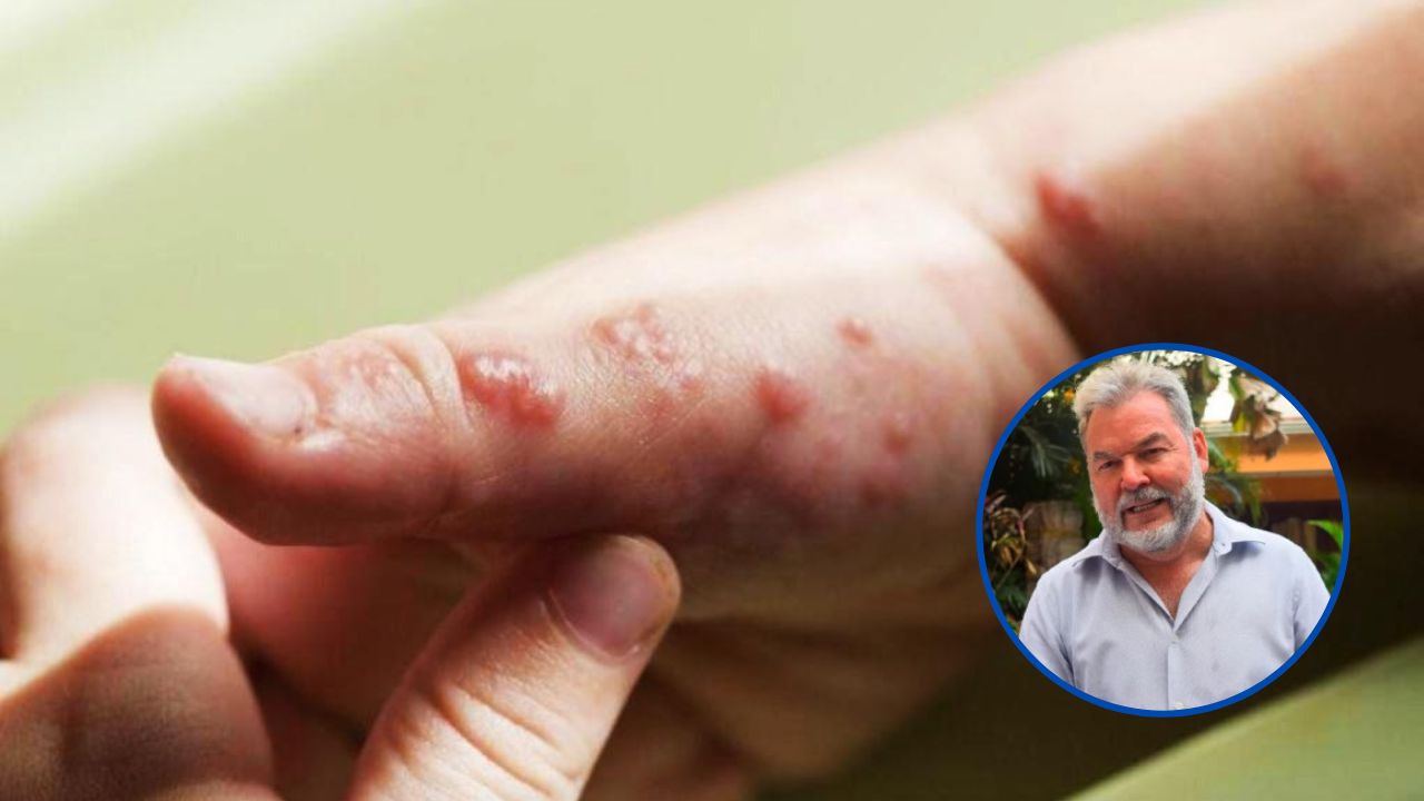 Confirman seis sospechosos de viruela del mono en San Pedro Sula