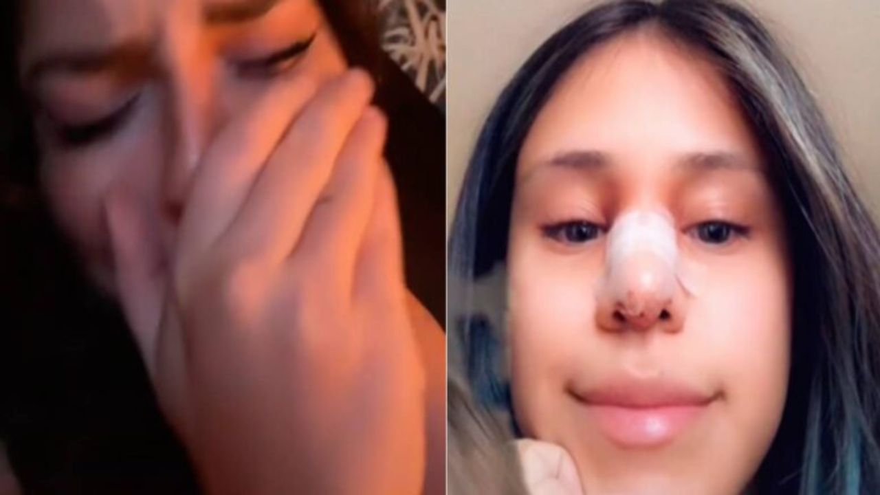 ¿Valió la pena? Le perdonó una infidelidad a su novio, pero le sacó una cirugía de nariz