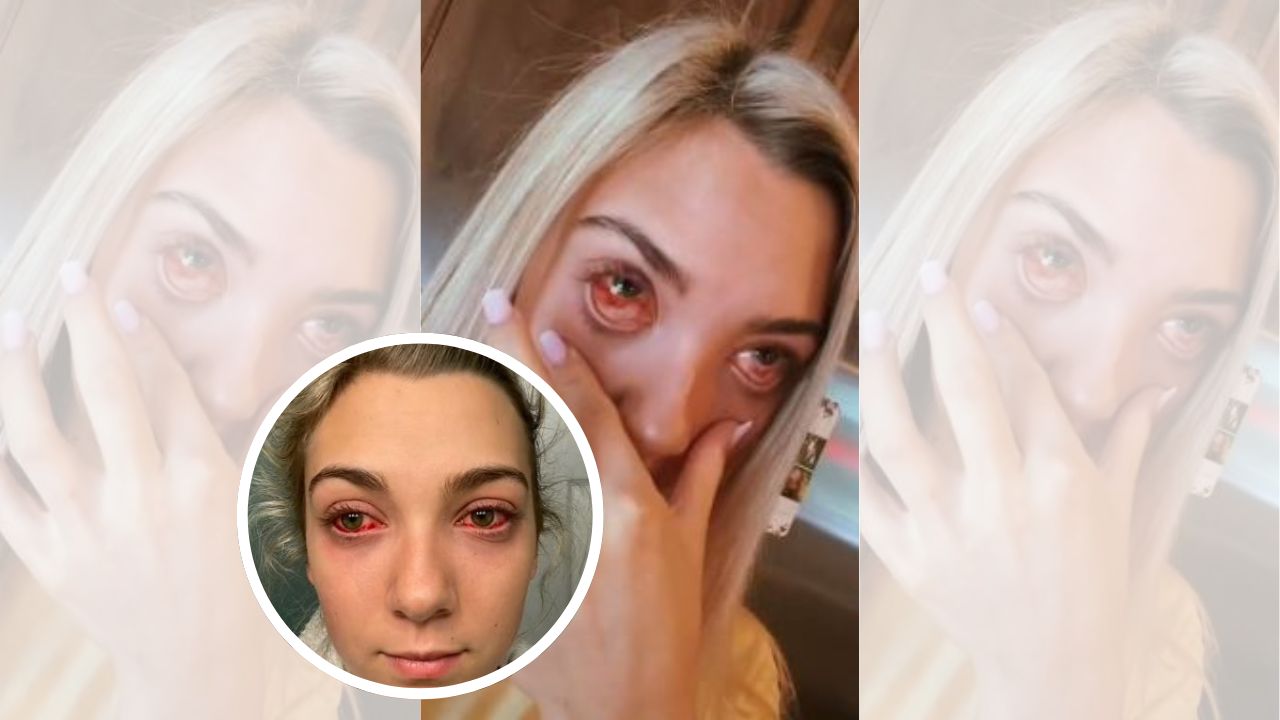 Joven quedó con ojos 'zombi' tras  procedimiento de extensión de pestañas