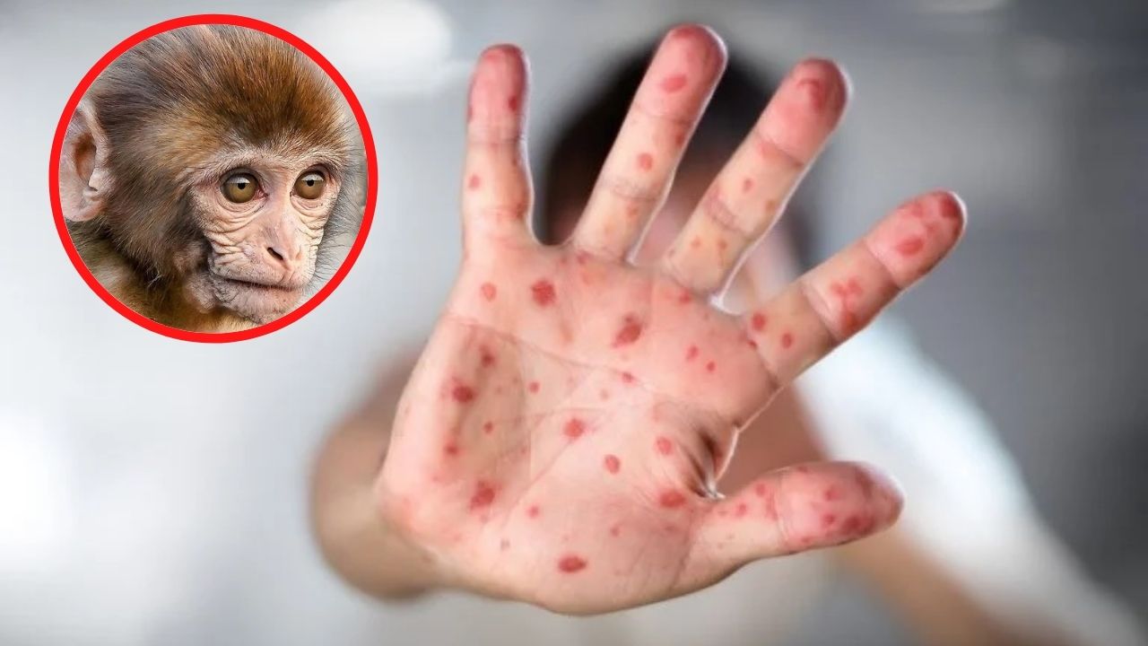 OMS registra más de 50.000 casos de viruela del mono en todo el mundo
