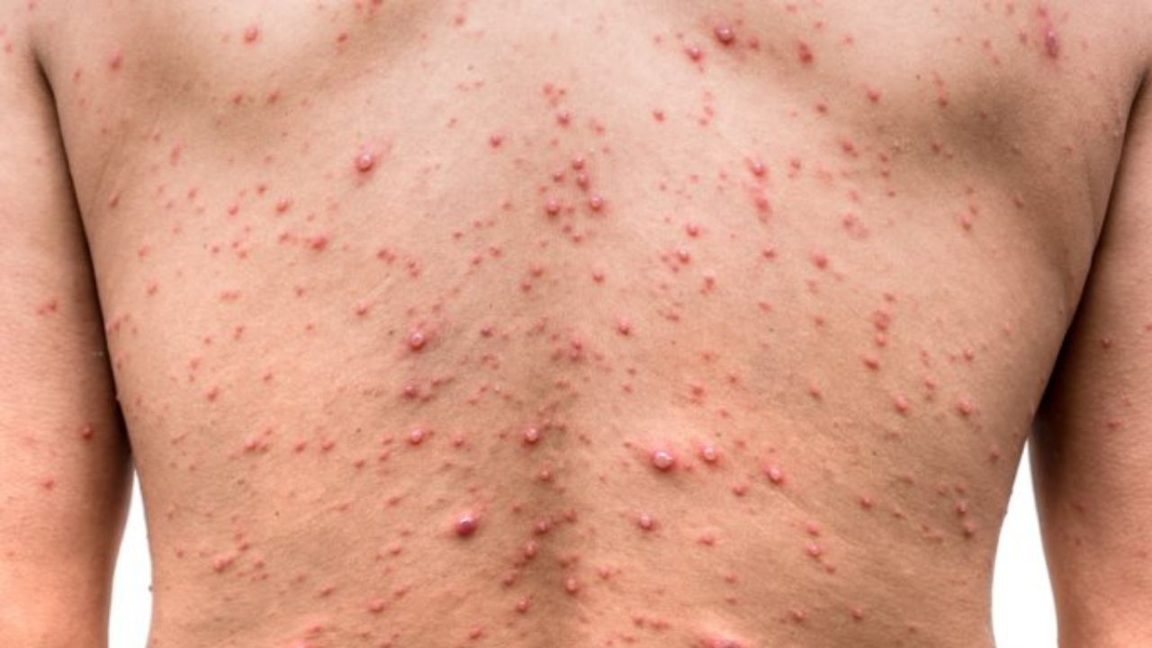 Ellos son los cuatro hondureños contagiados con la viruela del mono