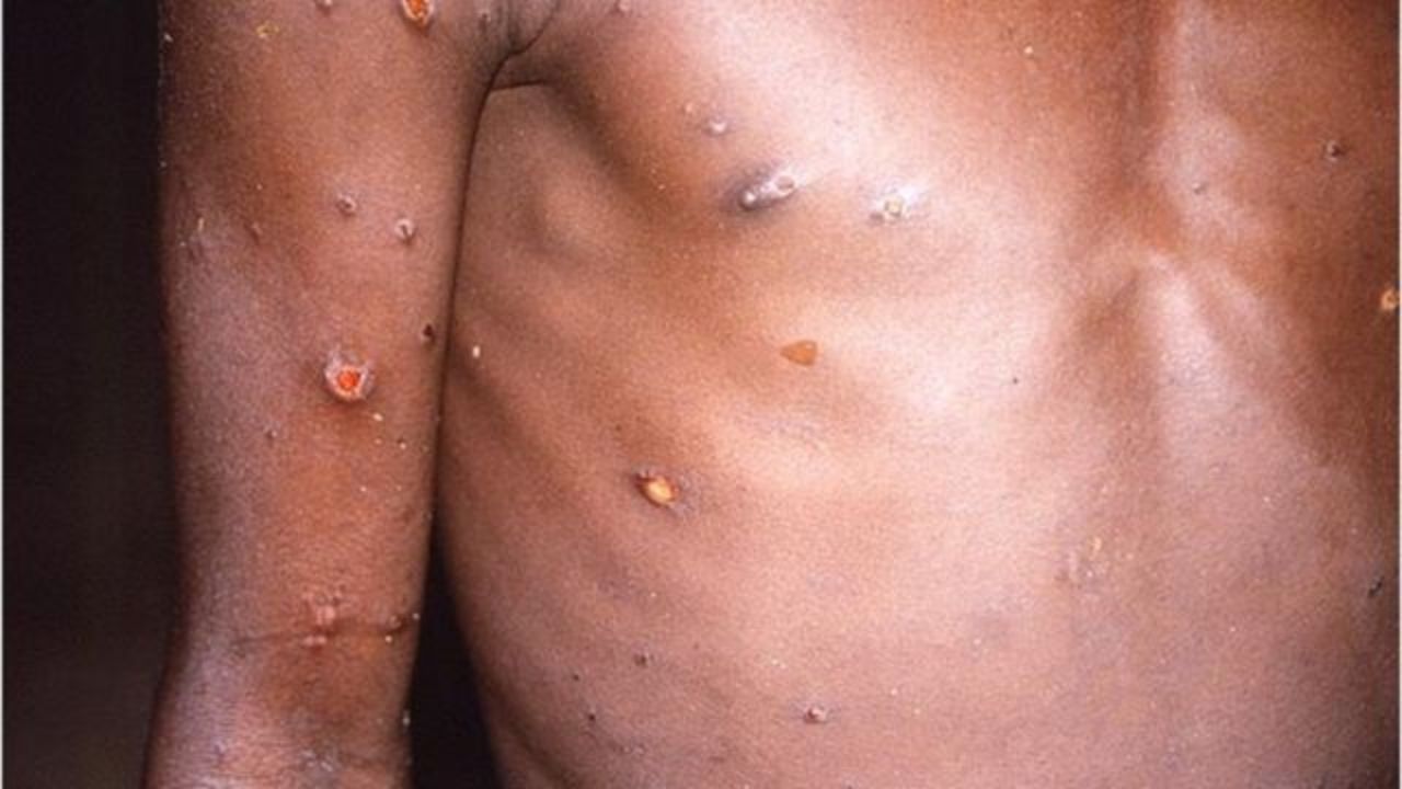 ¿Quiénes se pueden contagiar de la viruela del mono?, especialista hondureña explica