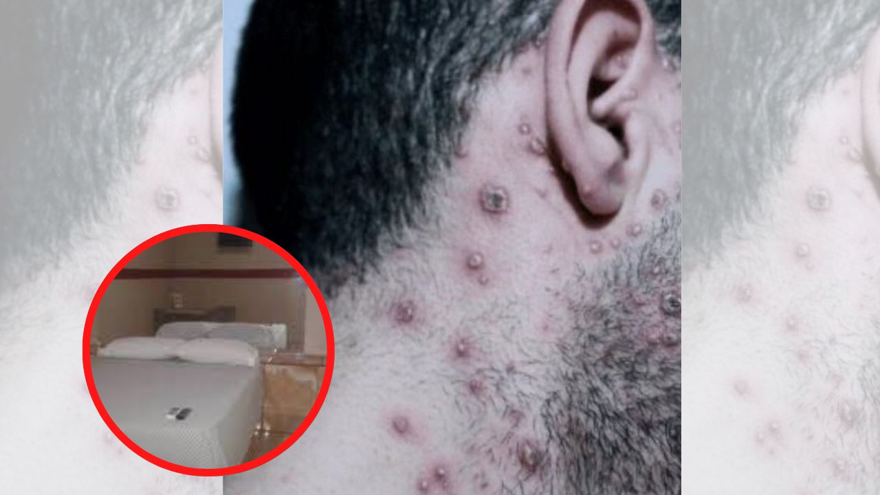 Carlos Umaña lanza advertencia a las personas promiscuas y esto dice sobre moteles ante riesgo de contagio de viruela del mono