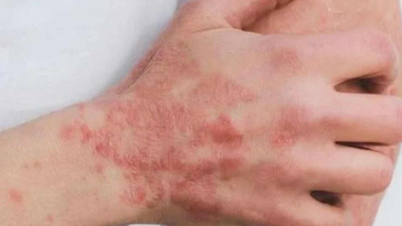 Si haces esto te puedes contagiar de viruela del mono, advierte ministro de Salud