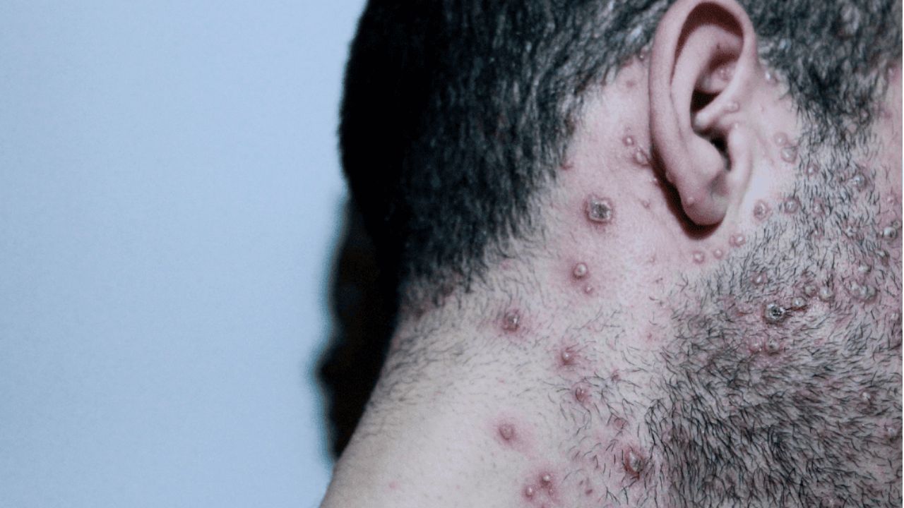 Otro hombre resulta positivo de viruela del mono en Honduras; suman 4 casos confirmados