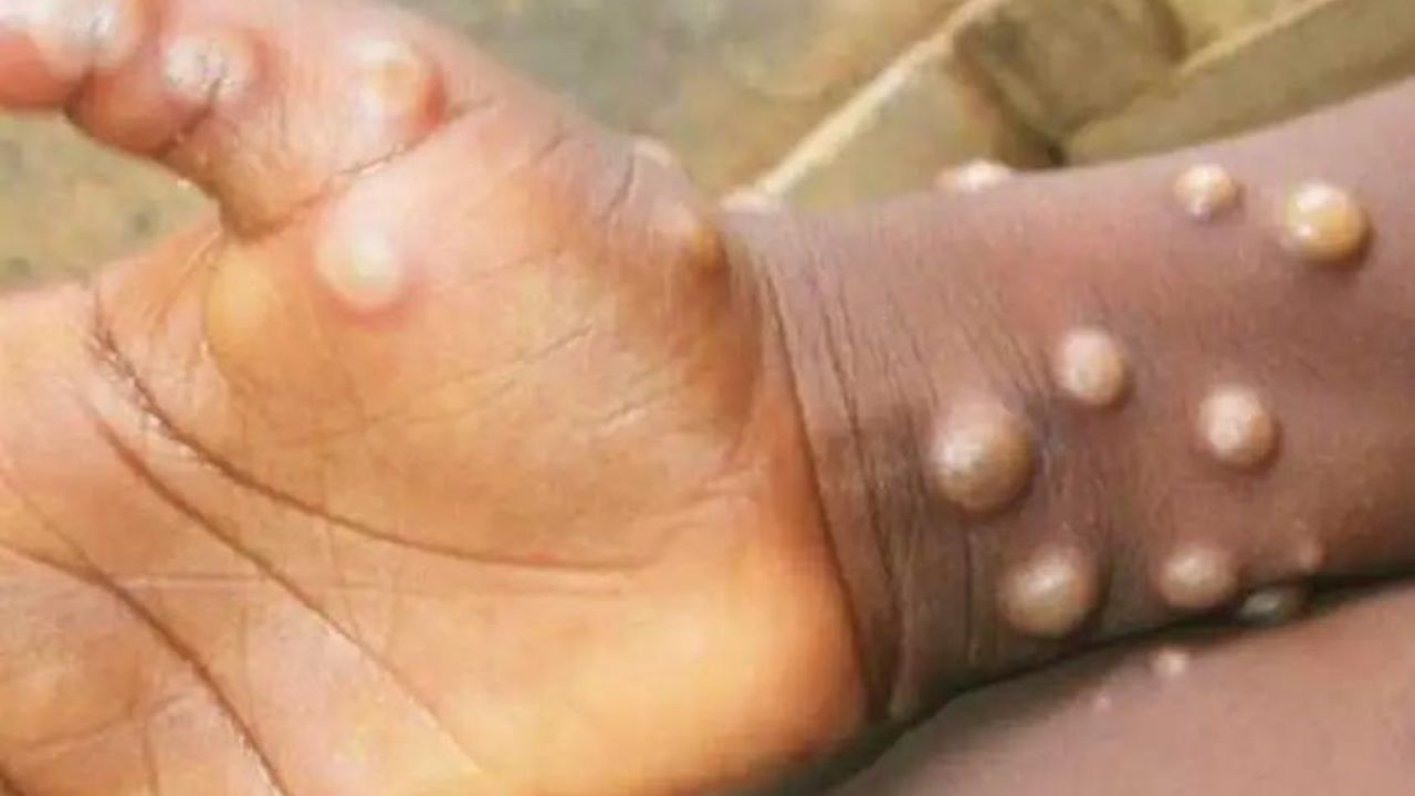 Los casos globales de viruela del mono superan los 26 mil; ya hay 9 muertes