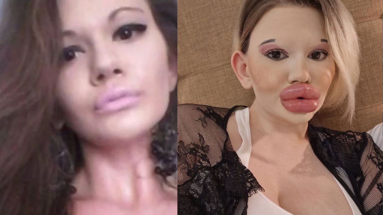 Este fue el resultado de la 'Barbie Humana' tras 30 inyecciones de ácido hialurónico en los labios