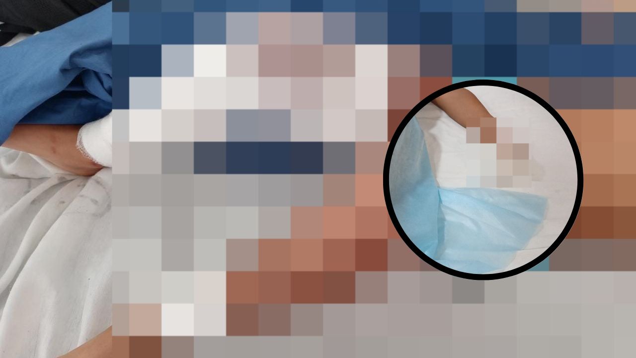 Una menor de edad resulta quemada por mortero en feria patronal de Orocuina, Choluteca