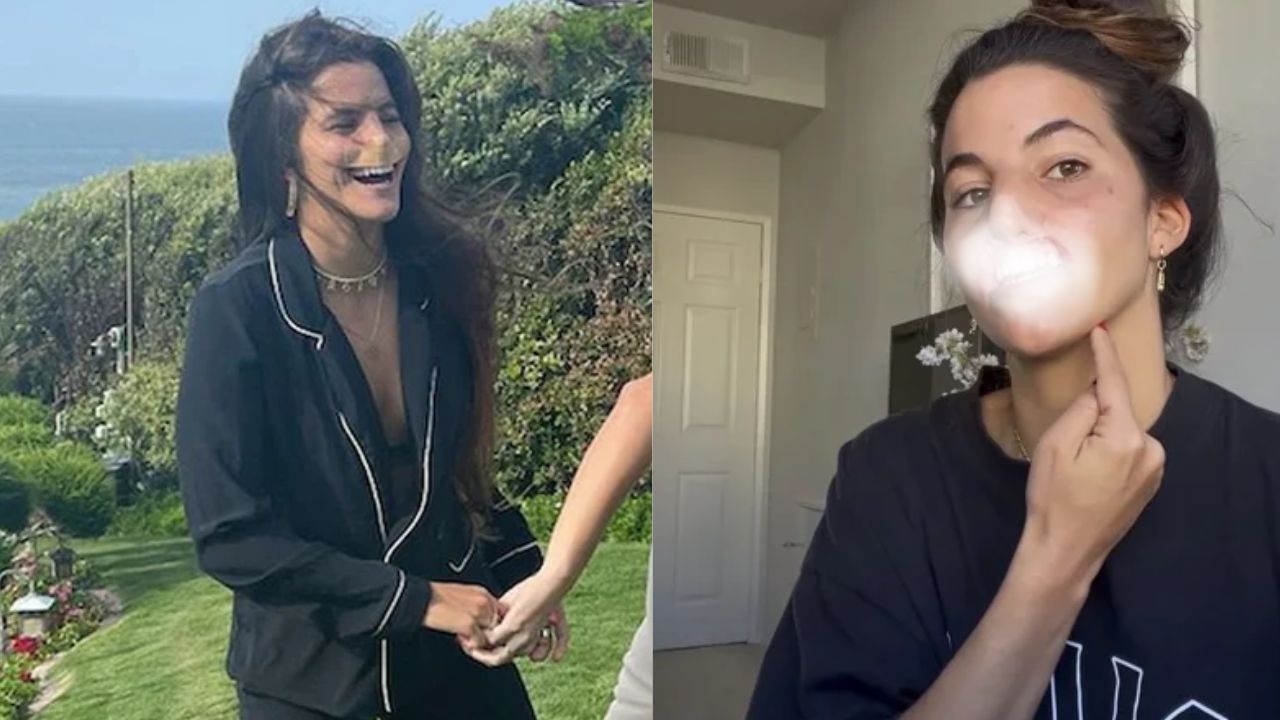 'Yo lo acariciaba y le decía eres un buen chico': Modelo perdió el labio por ataque de un pitbull