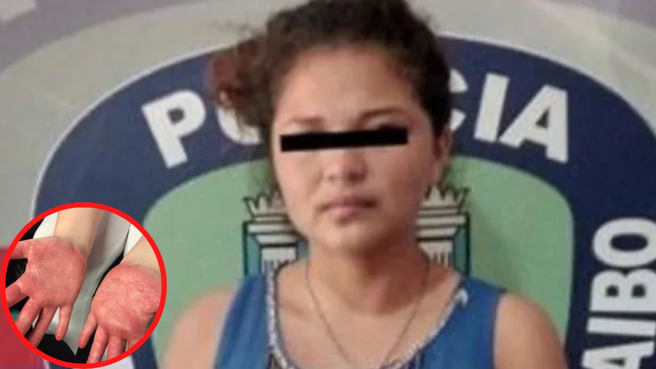 Mujer quema las manos de su hermana con discapacidad por tomar un dinero sin permiso