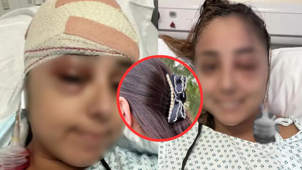 'Pensé que moriría': gancho de pelo se enterró en la cabeza de una joven tras accidente vial