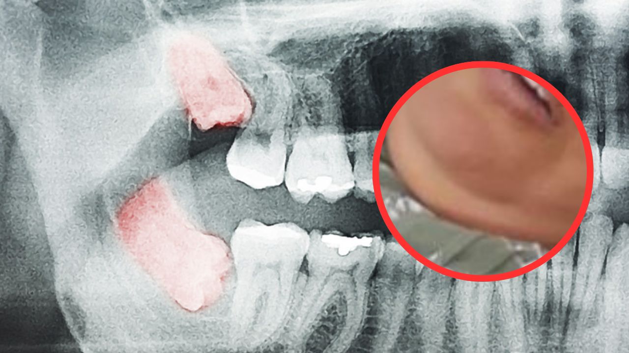 Hondureña, en estado de coma tras complicaciones por una muela; este es el caso