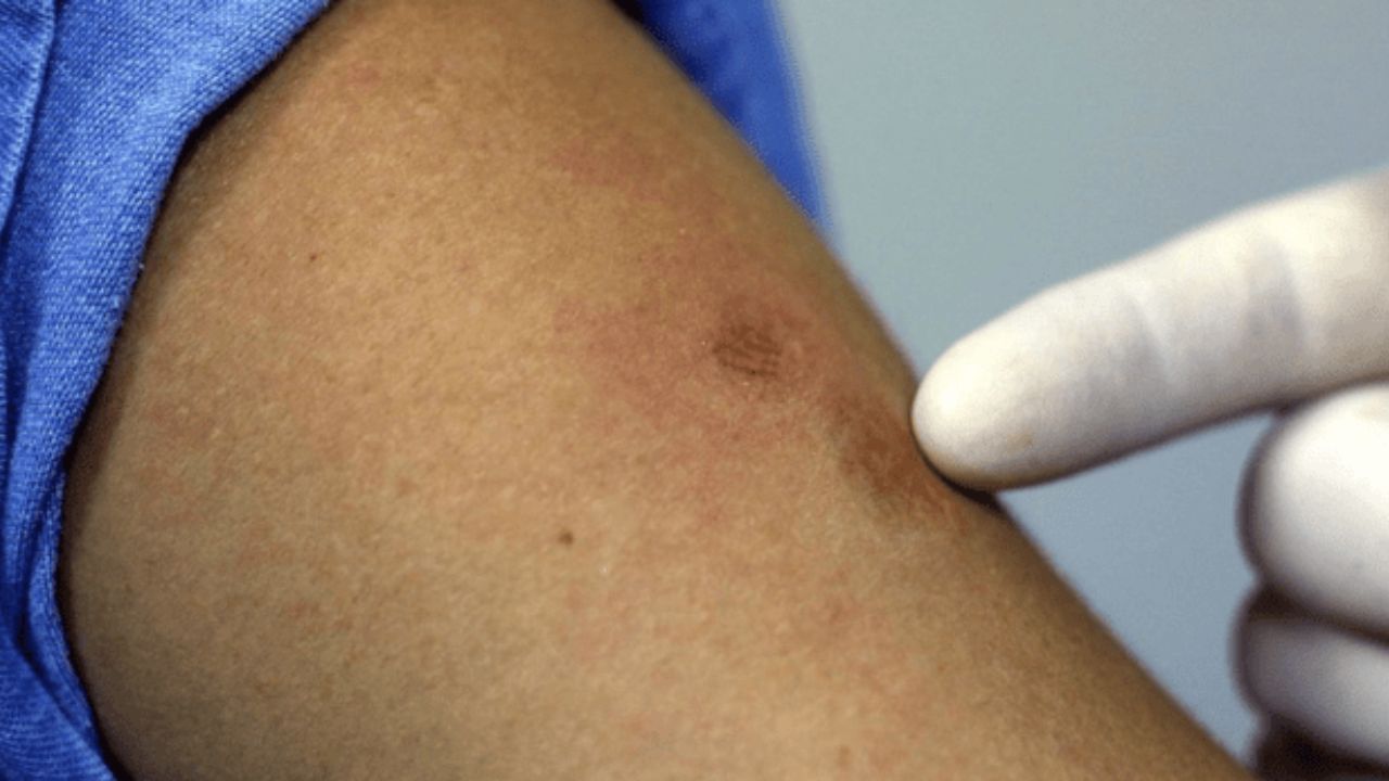 Casos de viruela símica en El Salvador suman más de 105 casos y no se reportan fallecidos