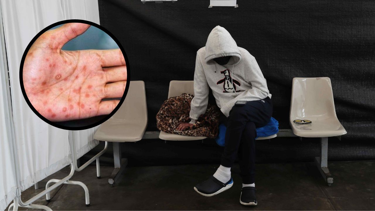 OMS puso fin a la emergencia internacional por la viruela del mono