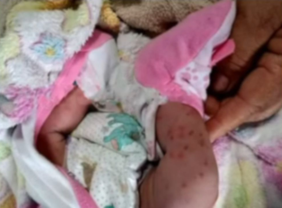 Según se mostró, la menor recibió varias picaduras de zancudo. Foto: HRN