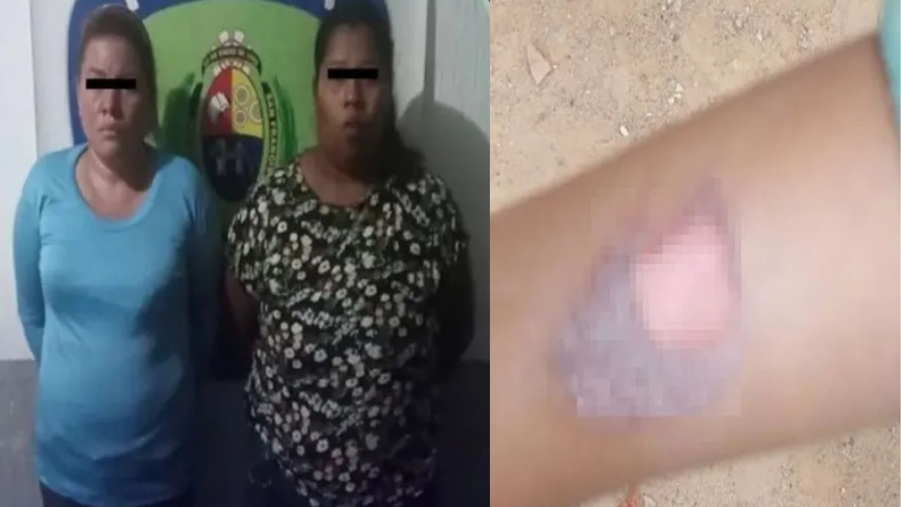 Imagen de Madre agresiva y su amiga castigaban a niña de 5 años quemándola con una cuchara