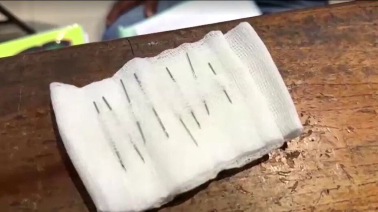 Los doctores pudieron extraer fácilmente las agujas. Foto: Captura América