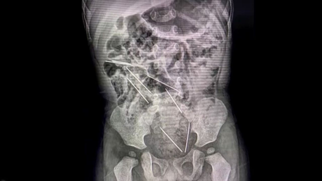 Ecografía abdominal del niño que tragó accidentalmente ocho agujas. Foto: Redes sociales