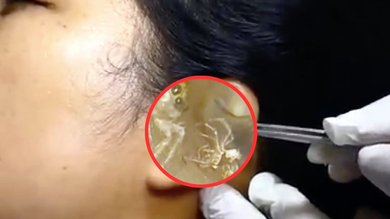 Impactante video de araña dentro de oído de mujer, ella sufría de fuertes dolores