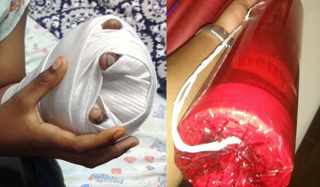 Imagen de Adolescente hondureño, el séptimo quemado de la temporada tras explotarle un mortero