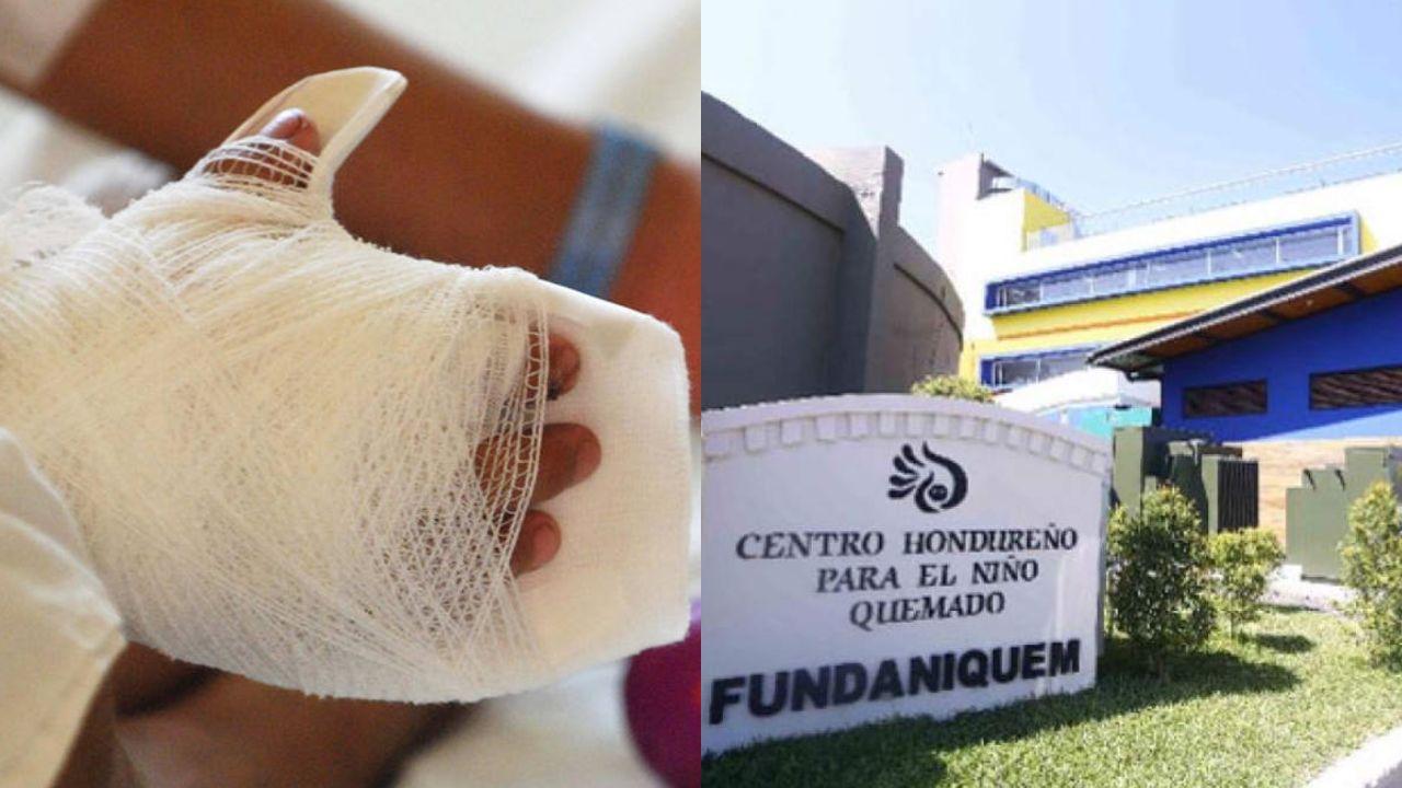 Imagen de Sube a 18 los niños ingresados a nivel nacional por quemaduras de pólvora