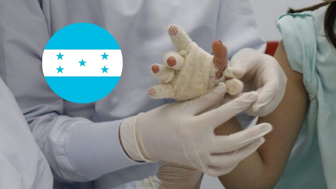 Más de 30 menores resultaron quemados por pólvora en Honduras durante la temporada navideña 2023
