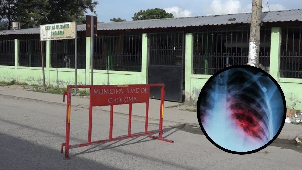 Aumentan casos de tuberculosis en Choloma, Cortés