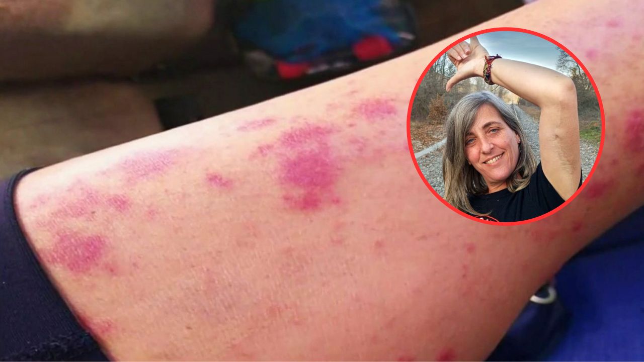Pensó que era la picada de un zancudo y casi muere por bacteria ‘come carne’