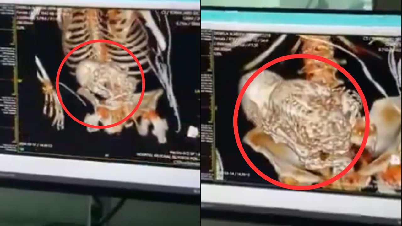 Octogenaria muere en Brasil al ser operada por 'tumor' que resultó ser un feto calcificado