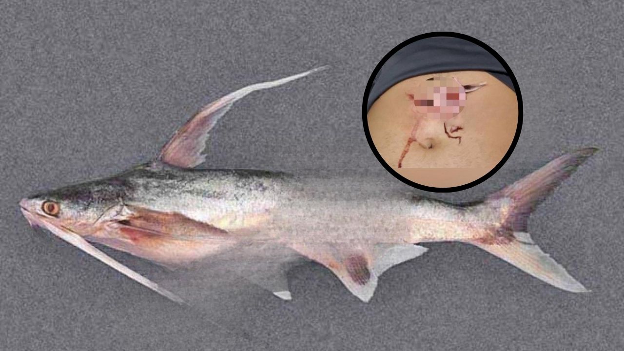 Hospitalizan a un hombre con una aleta de pez incrustada en su estómago