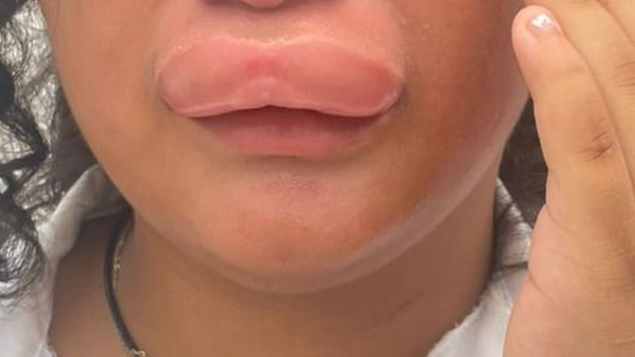 Alumna de colegio en Roatán terminó con su labio hinchado por ataque de abejas