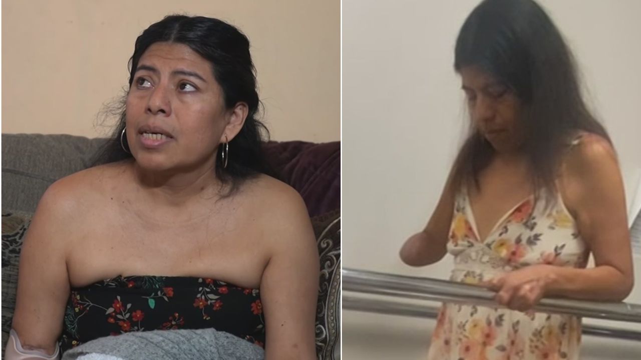 Mujer dice que comer carne de cerdo provocó la amputación de sus piernas y brazo izquierdo