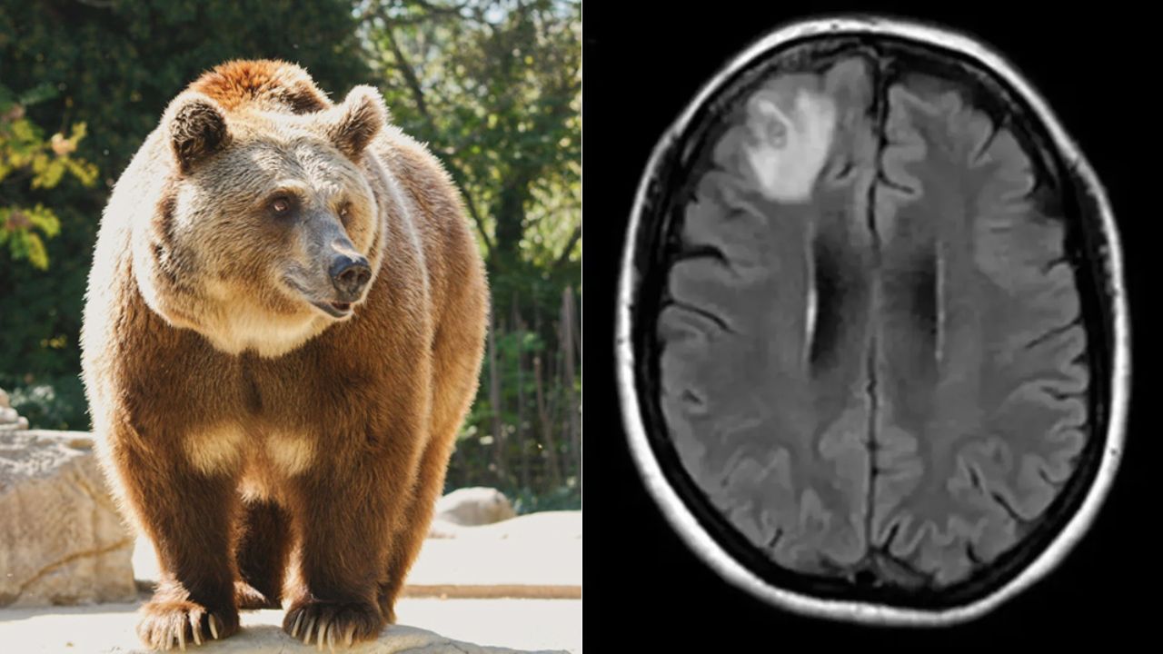 Familia contrae 'gusanos cerebrales' tras comer carne de oso