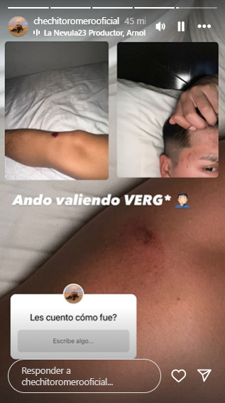 Heridas de Chechito en la historia que compartió
