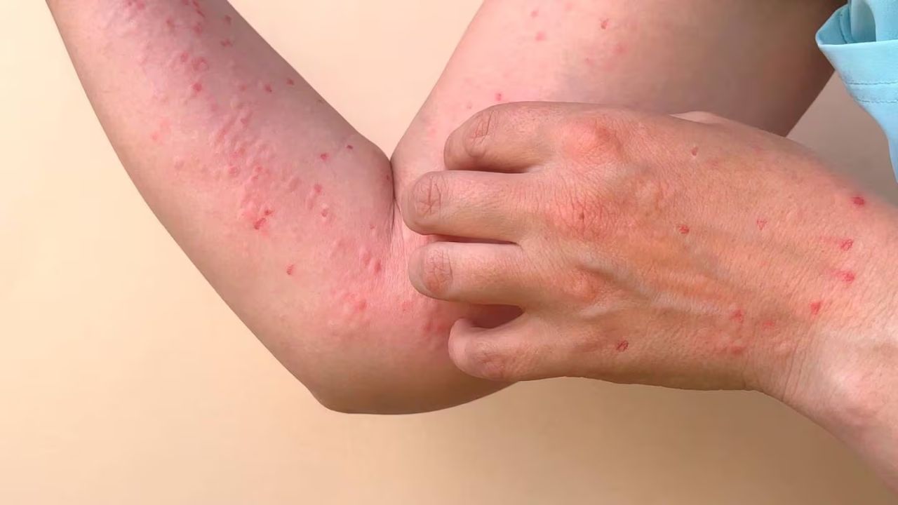 ¿Cómo empieza la viruela del mono en la persona infectada?