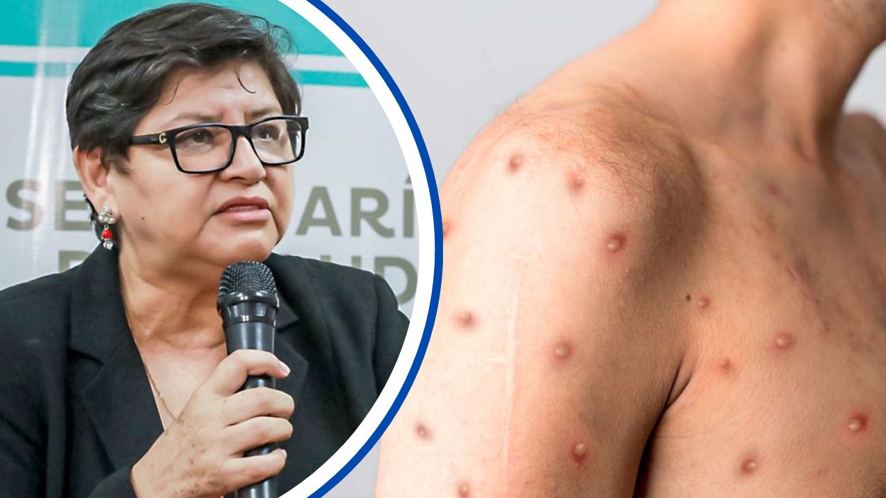 No es viruela del mono sino varicela lo que aqueja a familia hondureña, aclara Salud