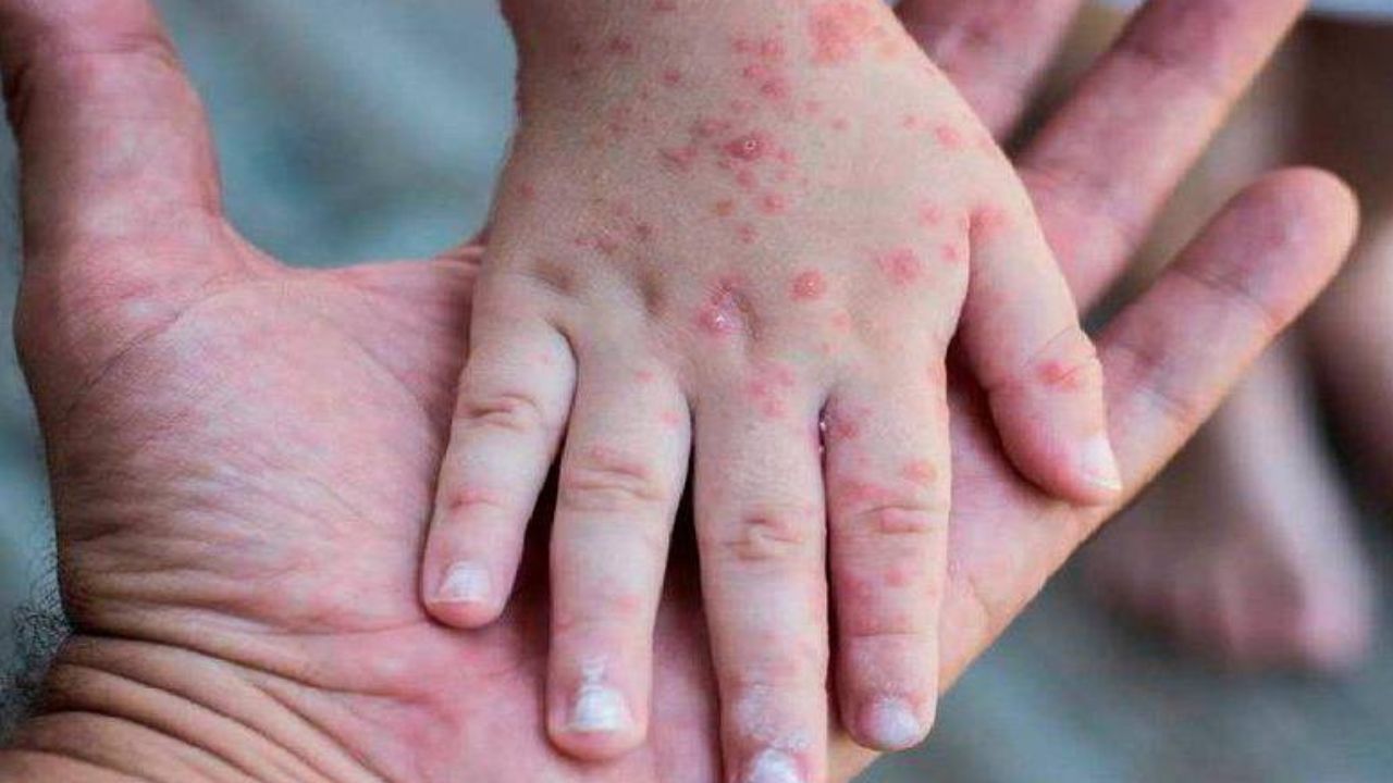 ¿Virus de viruela símica en Honduras?, alertan de síntomas en caso de sospechas