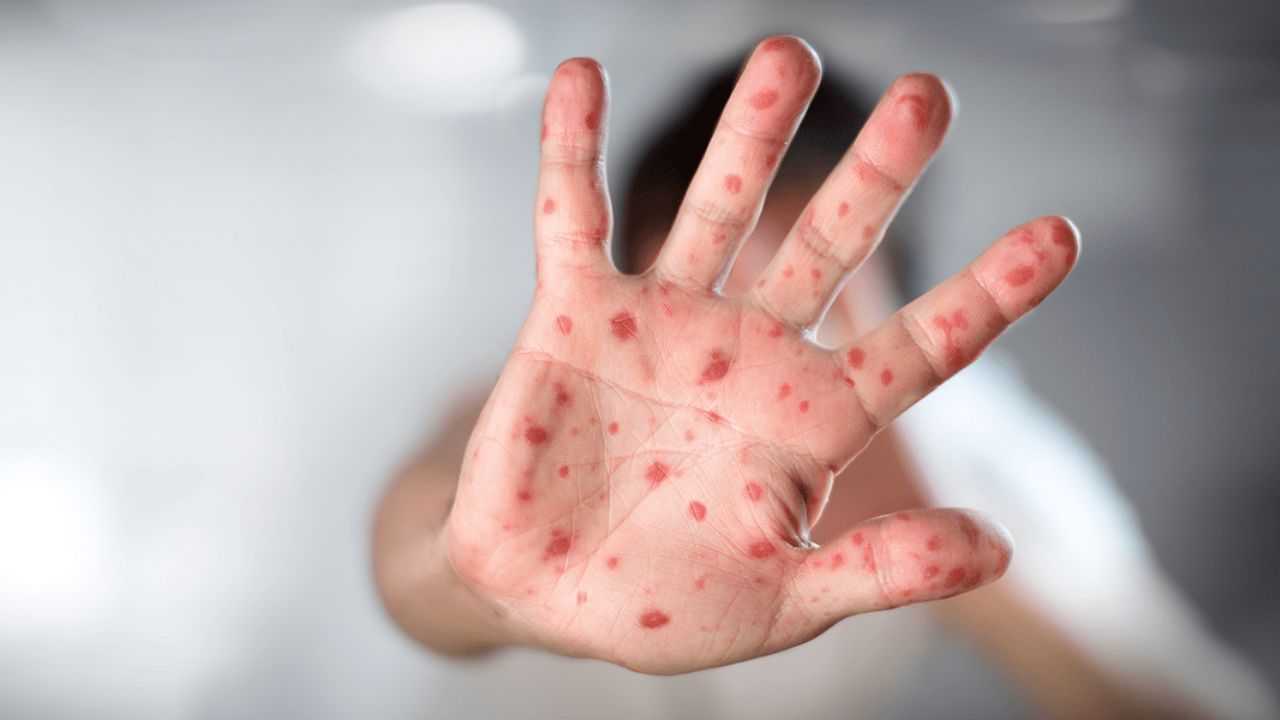 Viruela del mono, ¿cómo se contagia y cuáles son sus síntomas?