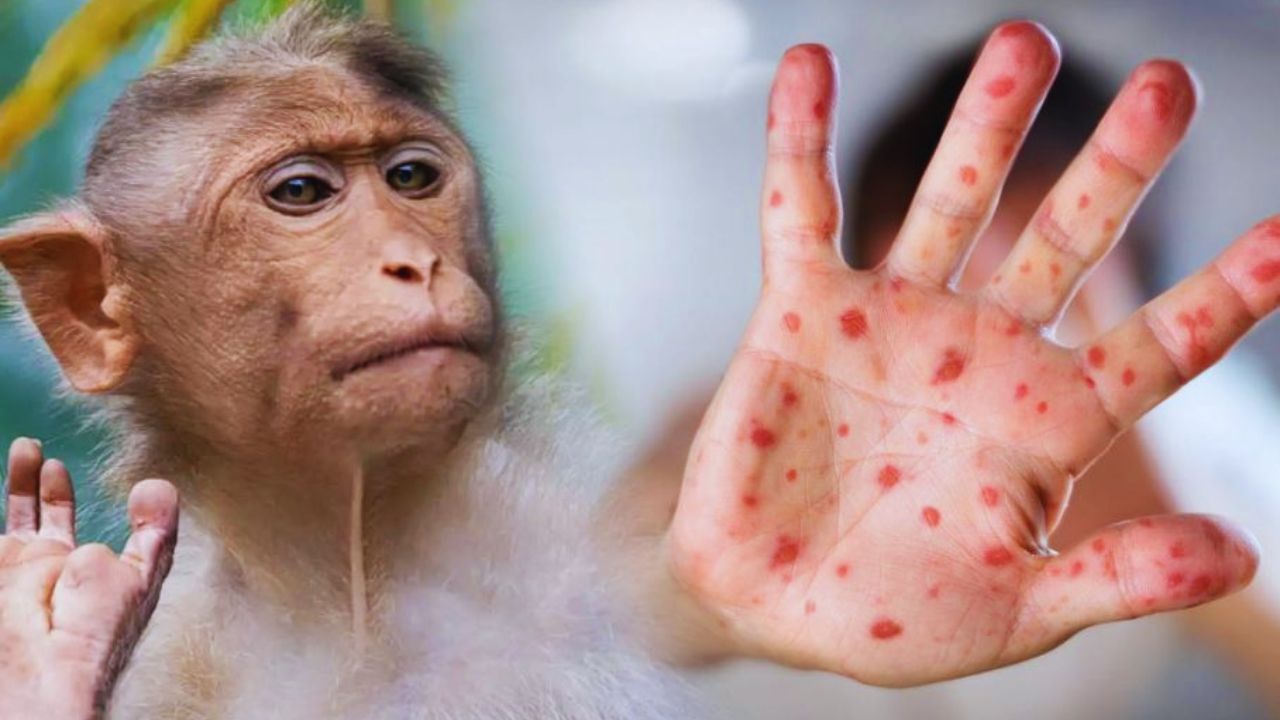 Viruela del mono podría llegar a Honduras este 2024, advierte epidemiólogo