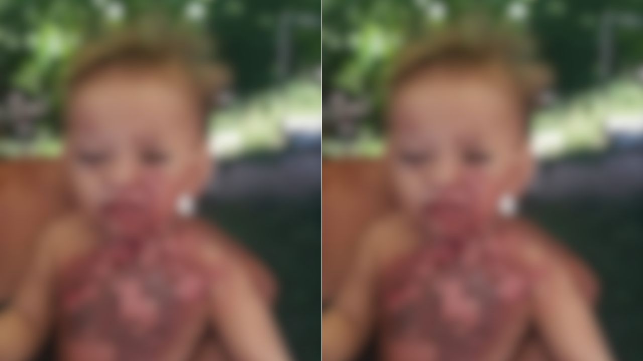 Menor sufre quemaduras graves luego de que pareja actual de su madre le lanzara agua caliente