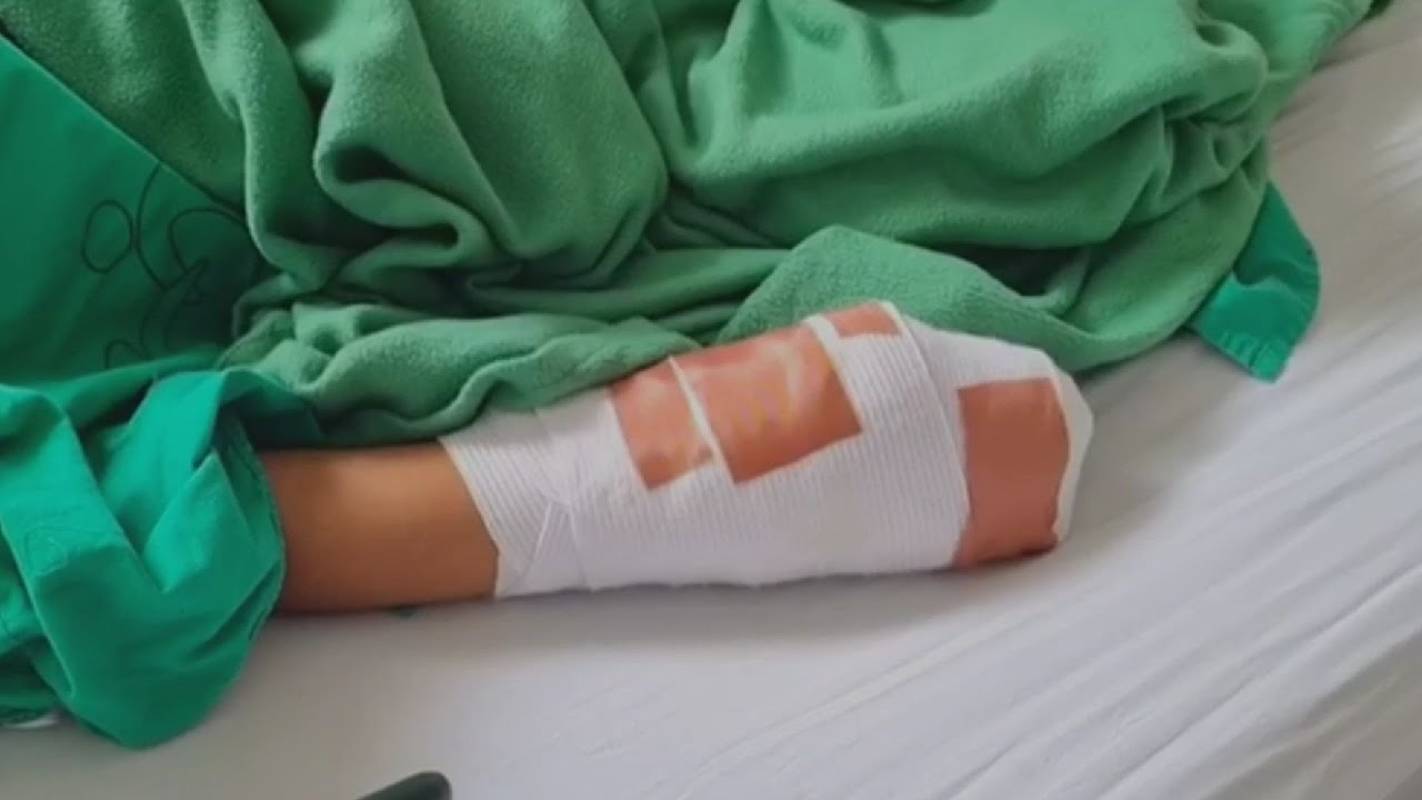 Tragedia en Navidad: Niño pierde la mano derecha por explosión de mortero en Roatán