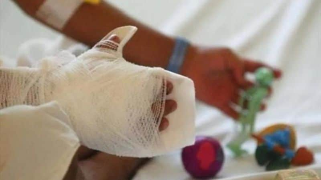 A 12 asciende la cifra de niños quemados en la temporada navideña
