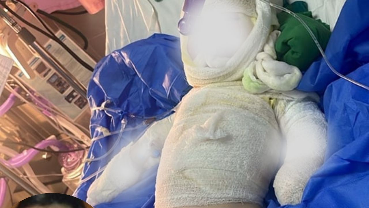 Niña de 13 meses en Copán permanece conectada a ventilación mecánica por quemaduras en el cuerpo