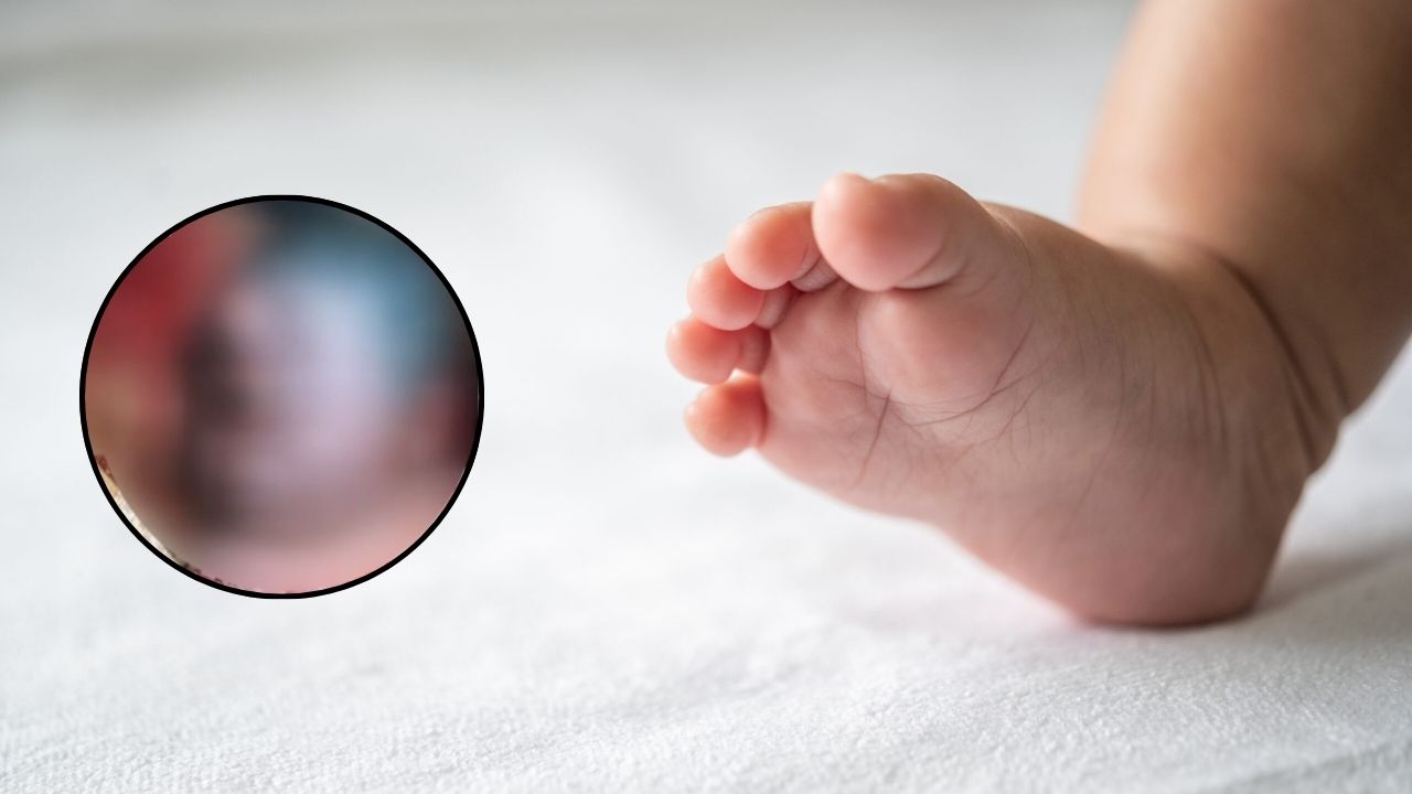 Nace bebé 'cíclope' por una malformación congénita, ¿dónde ocurrió?