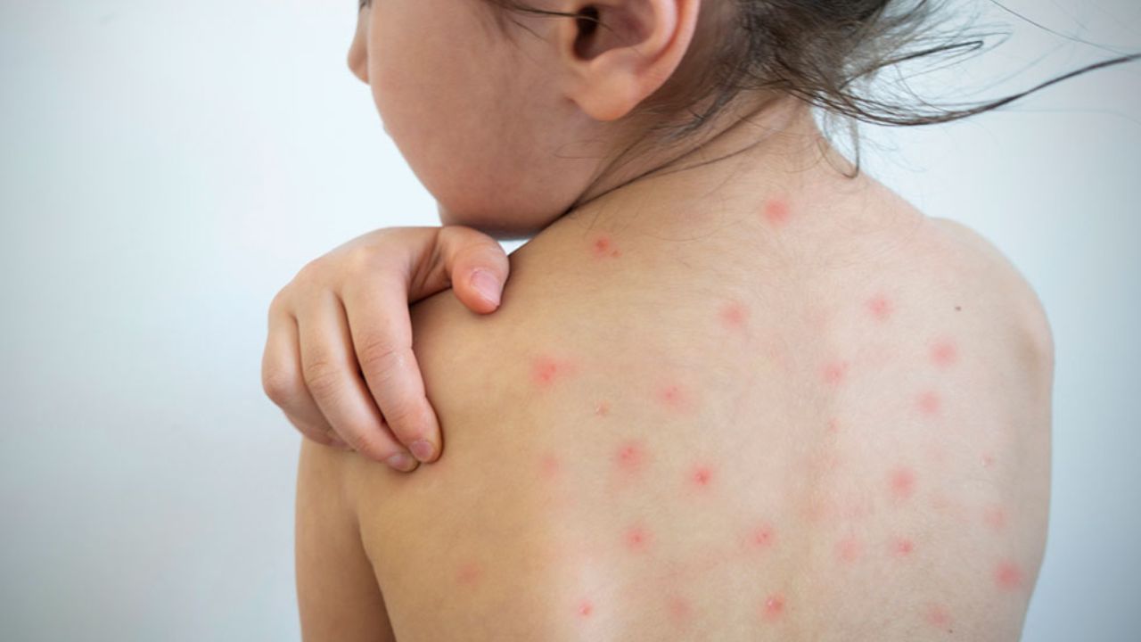 Alerta sanitaria por sarampión: ¿Qué debe saber y cómo protegerse?
