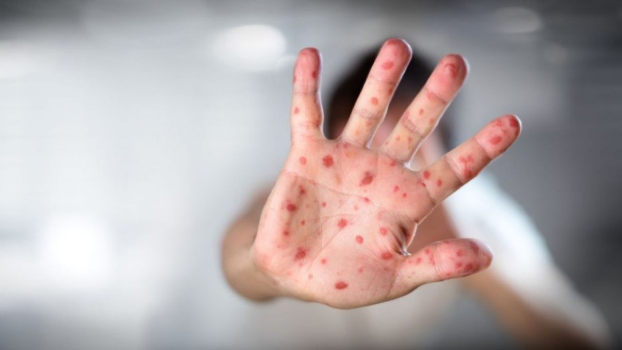 Declaran alerta sanitaria por sarampión en Honduras ante riesgo de brotes