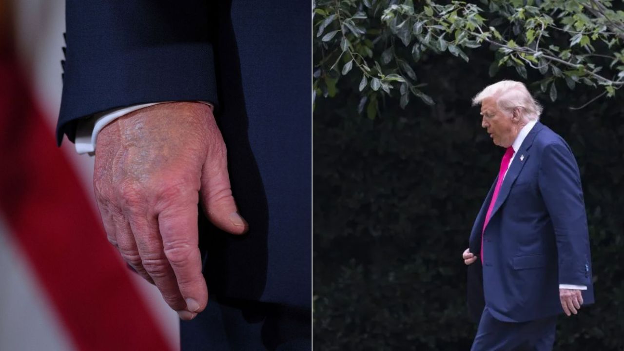 ¿Peligra la salud de Trump tras ser diagnosticado con insuficiencia venosa?